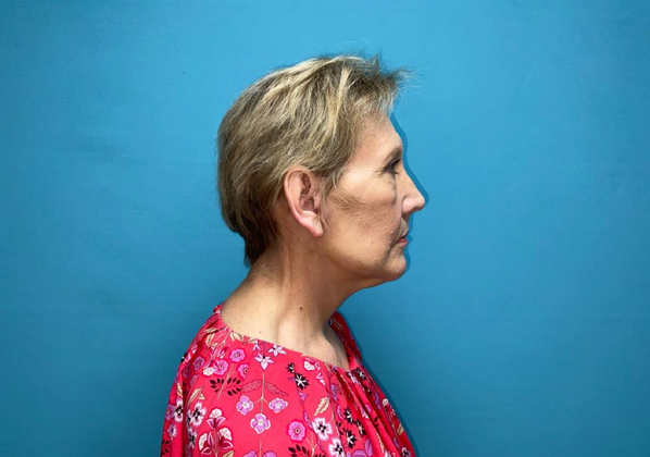 Facelift: Case 1 - After