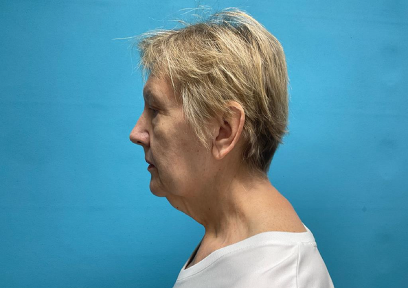 Facelift: Case 1 - Before