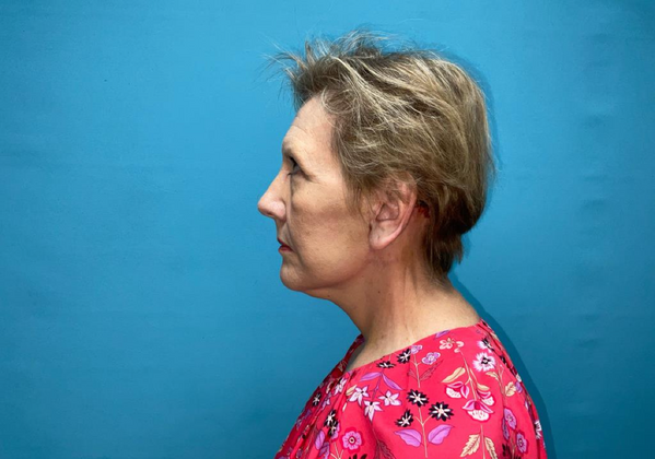 Facelift: Case 1 - After