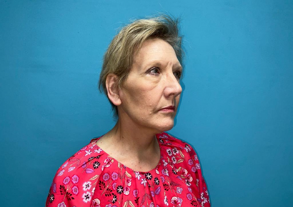 Facelift: Case 1 - After