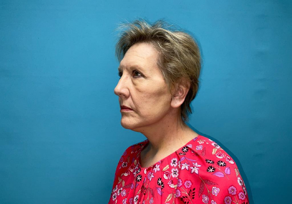 Facelift: Case 1 - After