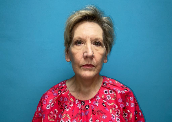 Facelift Case 1 - After