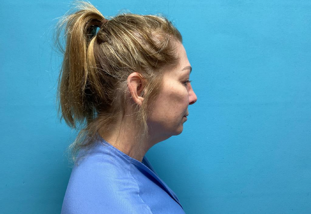 Blepharoplasty: Case 1 - Before