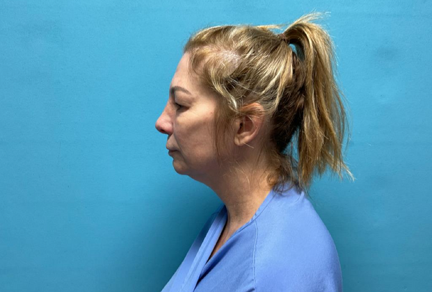 Blepharoplasty: Case 1 - Before