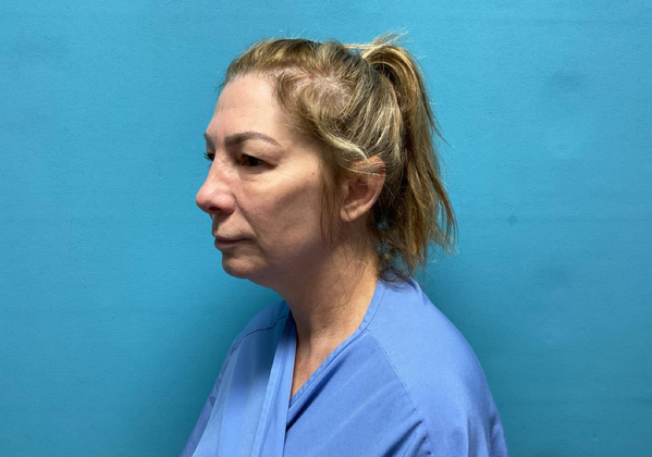 Blepharoplasty: Case 1 - Before