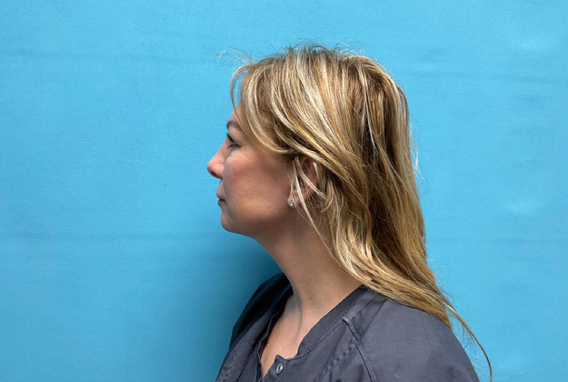 Blepharoplasty: Case 1 - After