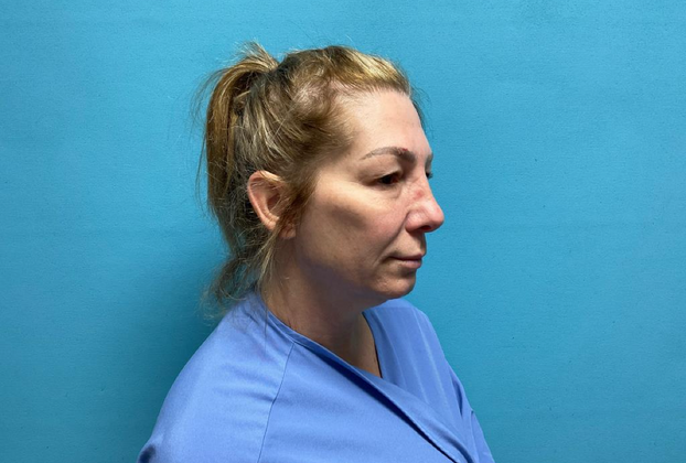 Blepharoplasty: Case 1 - Before