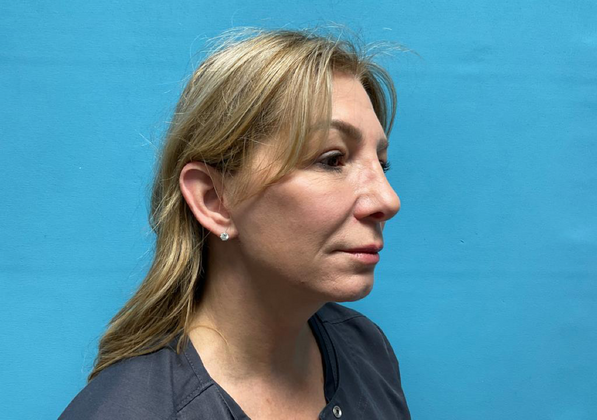 Blepharoplasty: Case 1 - After