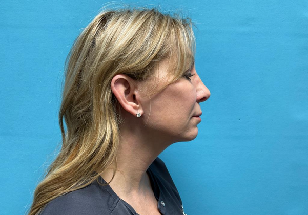 Blepharoplasty: Case 1 - After