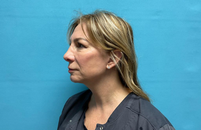 Blepharoplasty: Case 1 - After