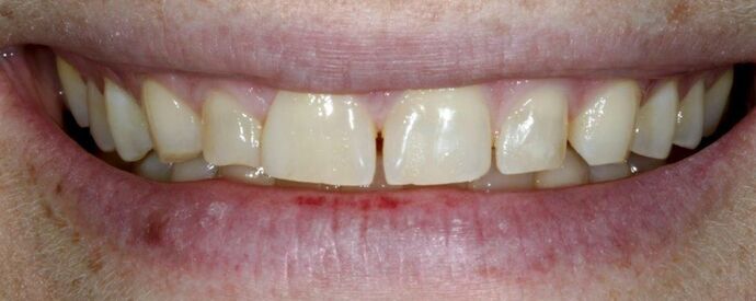 Smile Makeover & Veneers: Brynn - Before