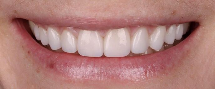 Smile Makeover & Veneers Brynn