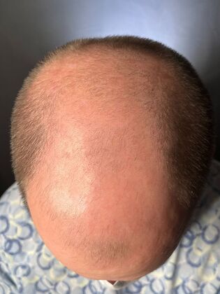 FUE Hair Restoration: Case 44 - Before
