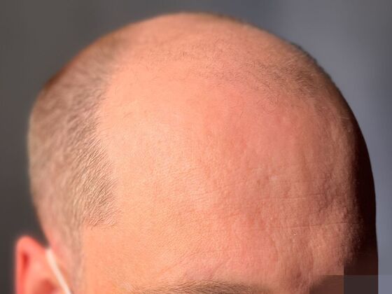 FUE Hair Restoration: Case 44 - Before