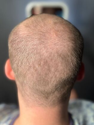 FUE Hair Restoration: Case 44 - Before