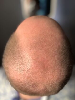FUE Hair Restoration: Case 44 - After