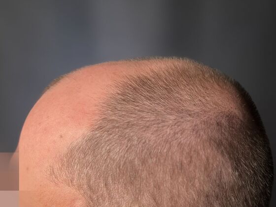 FUE Hair Restoration: Case 44 - Before