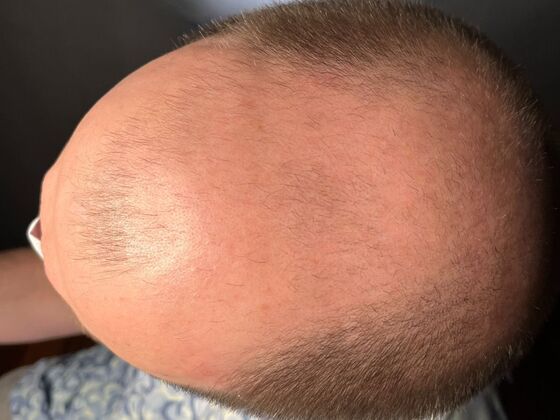 FUE Hair Restoration: Case 44 - Before