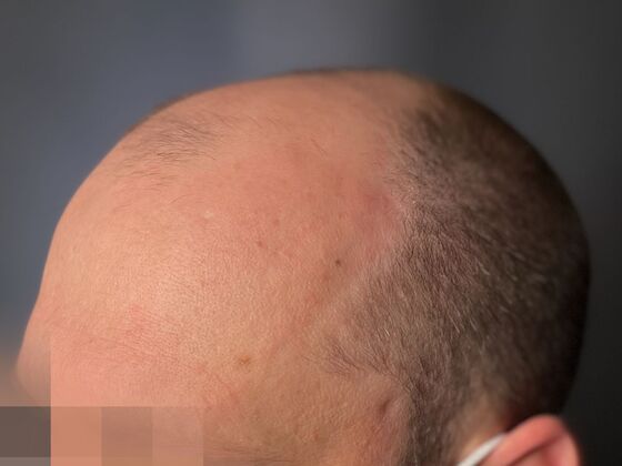FUE Hair Restoration: Case 44 - Before