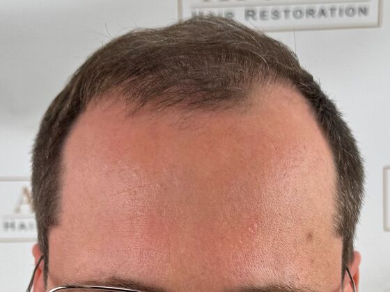 FUE Hair Restoration: Case 44 - After
