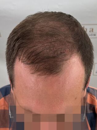 FUE Hair Restoration: Case 44 - After