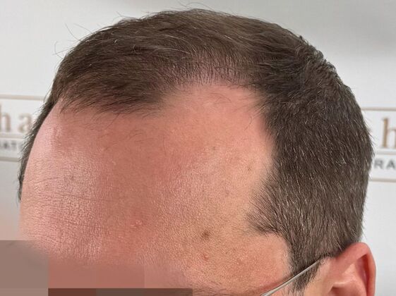 FUE Hair Restoration: Case 44 - After