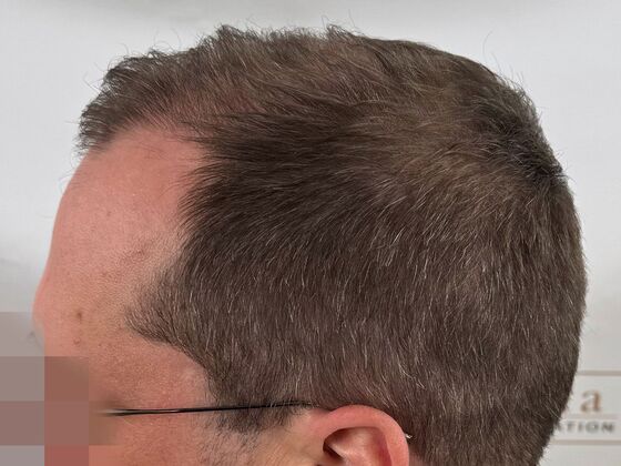 FUE Hair Restoration: Case 44 - After