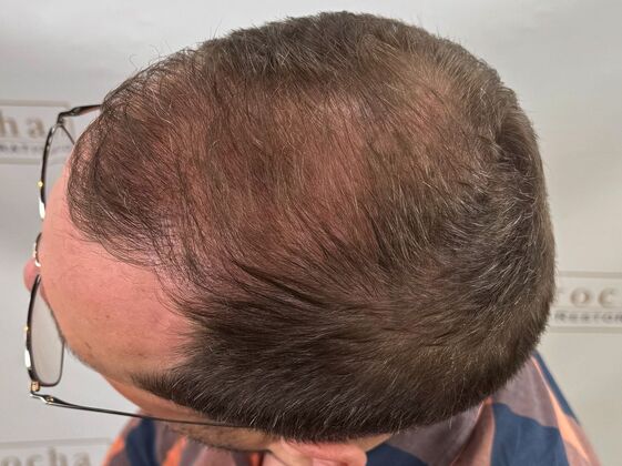 FUE Hair Restoration: Case 44 - After