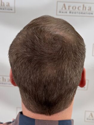 FUE Hair Restoration: Case 44 - After