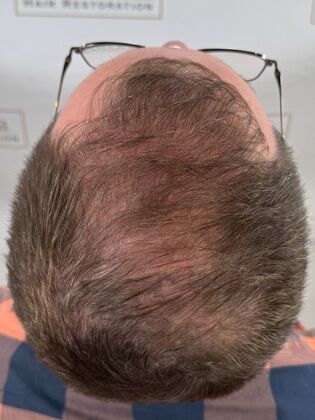 FUE Hair Restoration: Case 44 - Before