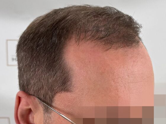 FUE Hair Restoration: Case 44 - After