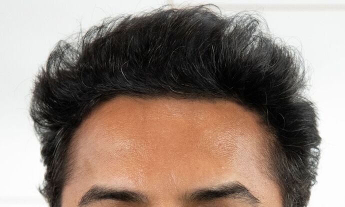 FUE Hair Restoration: Case 45 - After