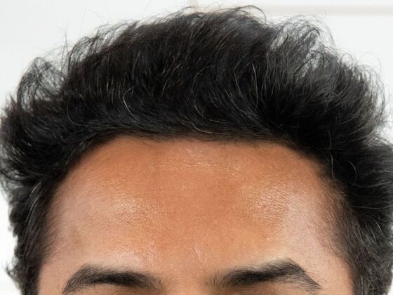 FUE Hair Restoration: Case 45 - After