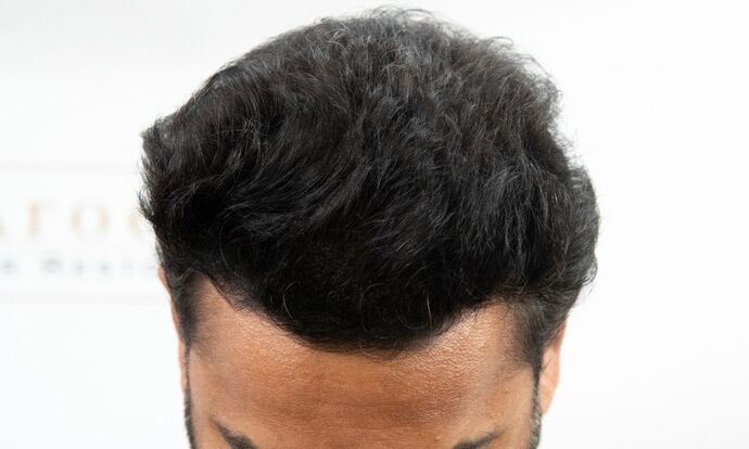 FUE Hair Restoration: Case 45 - After