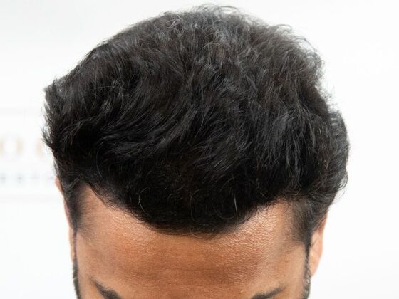 FUE Hair Restoration Case 45 - After
