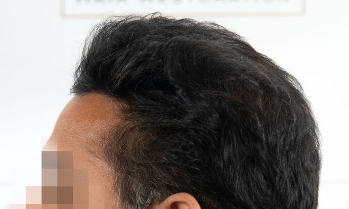 FUE Hair Restoration: Case 45 - After