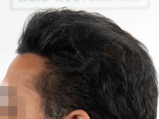 FUE Hair Restoration: Case 45 - After