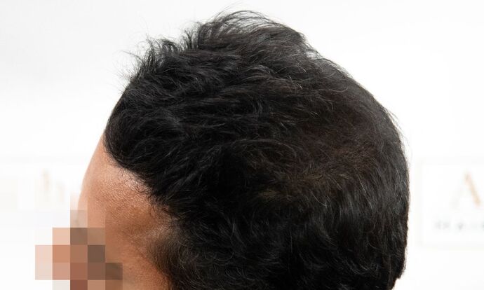 FUE Hair Restoration: Case 45 - After