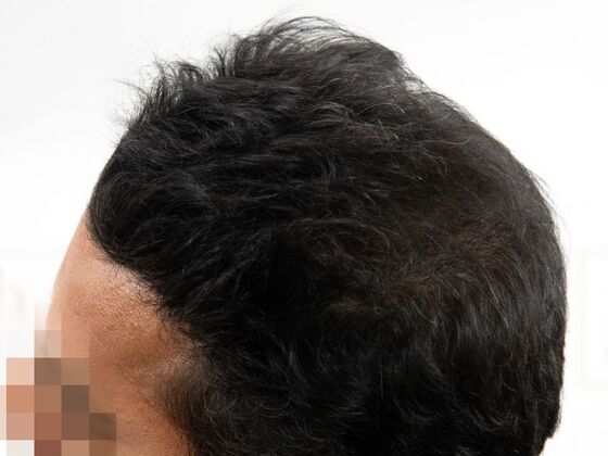 FUE Hair Restoration: Case 45 - After