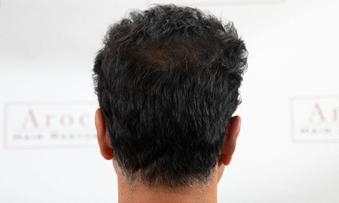 FUE Hair Restoration: Case 45 - After