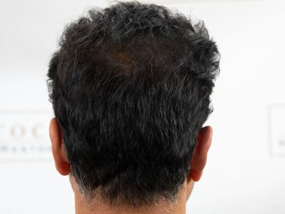 FUE Hair Restoration: Case 45 - After