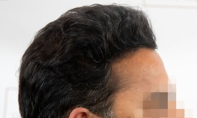 FUE Hair Restoration: Case 45 - After