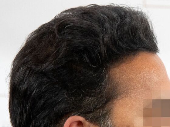 FUE Hair Restoration: Case 45 - After