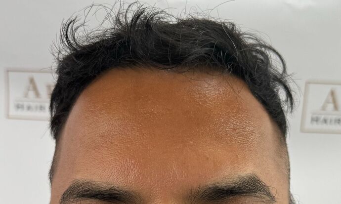 FUE Hair Restoration: Case 45 - Before