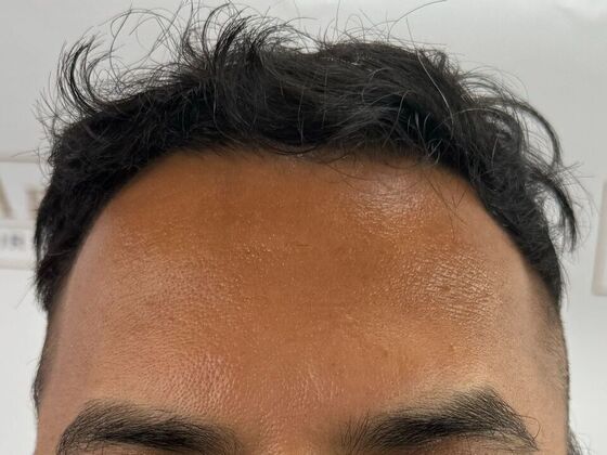 FUE Hair Restoration: Case 45 - Before