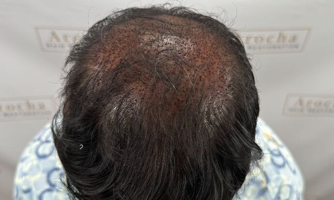 FUE Hair Restoration: Case 45 - Before