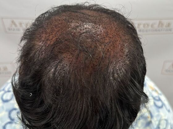 FUE Hair Restoration Case 45 - Before