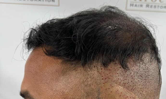 FUE Hair Restoration: Case 45 - Before
