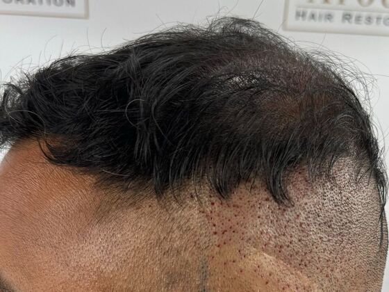 FUE Hair Restoration: Case 45 - Before