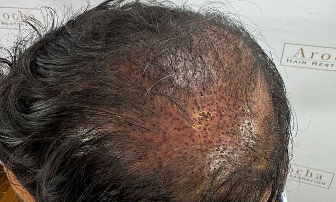 FUE Hair Restoration: Case 45 - Before